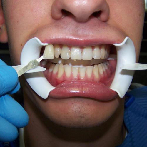 Bleaching voor